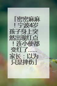 密密麻麻！宁波4岁孩子身上突然出现红点！连小便都变红了……家长：以为只是摔伤